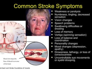 Common Stroke SymptomsCommon Stroke Symptoms
 Weakness or paralysisWeakness or paralysis
 Numbness, tingling, decreasedNumbness, tingling, decreased
sensationsensation
 Vision changesVision changes
 Speech problemsSpeech problems
 Swallowing difficulties orSwallowing difficulties or
droolingdrooling
 Loss of memoryLoss of memory
 Vertigo (spinning sensation)Vertigo (spinning sensation)
 Loss of balance andLoss of balance and
coordinationcoordination
 Personality changesPersonality changes
 Mood changes (depression,Mood changes (depression,
apathy)apathy)
 Drowsiness, lethargy, or loss ofDrowsiness, lethargy, or loss of
consciousnessconsciousness
 Uncontrollable eye movementsUncontrollable eye movements
or eyelid droopingor eyelid drooping
 