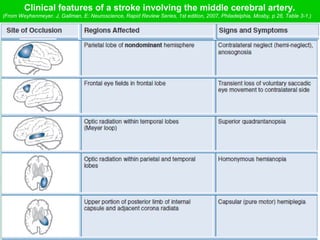 Clinical features of a stroke involving the middle cerebral artery.
(From Weyhenmeyer, J, Gallman, E: Neuroscience, Rapid Review Series, 1st edition, 2007, Philadelphia, Mosby, p 28, Table 3-1.)
 