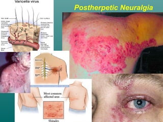 Postherpetic Neuralgia
 