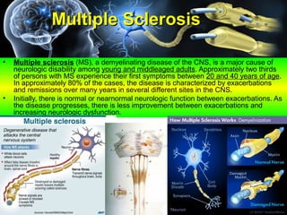 Multiple SclerosisMultiple Sclerosis
• Multiple sclerosis (MS), a demyelinating disease of the CNS, is a major cause of
neurologic disability among young and middleaged adults. Approximately two thirds
of persons with MS experience their first symptoms between 20 and 40 years of age.
In approximately 80% of the cases, the disease is characterized by exacerbations
and remissions over many years in several different sites in the CNS.
• Initially, there is normal or nearnormal neurologic function between exacerbations. As
the disease progresses, there is less improvement between exacerbations and
increasing neurologic dysfunction.
 
