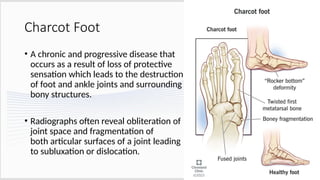 Comprehensive Overview of Diabetic Charcot Arthropathy Pathophysiology ...