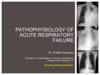 PATHOPHYSIOLOGY OF ACUTE RESPIRATORY FAILURE Dr. Andrew Ferguson   Consultant in Anaesthetics &  Intensive Care Medicine Craigavon Area Hospital, U.K.   http://www.slideshare.net/fergua   