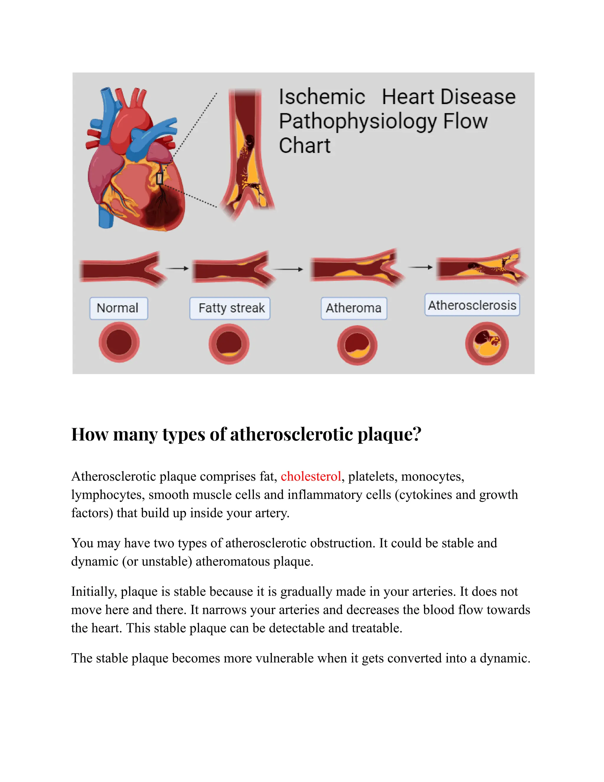 How many types of atherosclerotic plaque?
Atherosclerotic plaque comprises fat, cholesterol, platelets, monocytes,
lymphocytes, smooth muscle cells and inflammatory cells (cytokines and growth
factors) that build up inside your artery.
You may have two types of atherosclerotic obstruction. It could be stable and
dynamic (or unstable) atheromatous plaque.
Initially, plaque is stable because it is gradually made in your arteries. It does not
move here and there. It narrows your arteries and decreases the blood flow towards
the heart. This stable plaque can be detectable and treatable.
The stable plaque becomes more vulnerable when it gets converted into a dynamic.
 