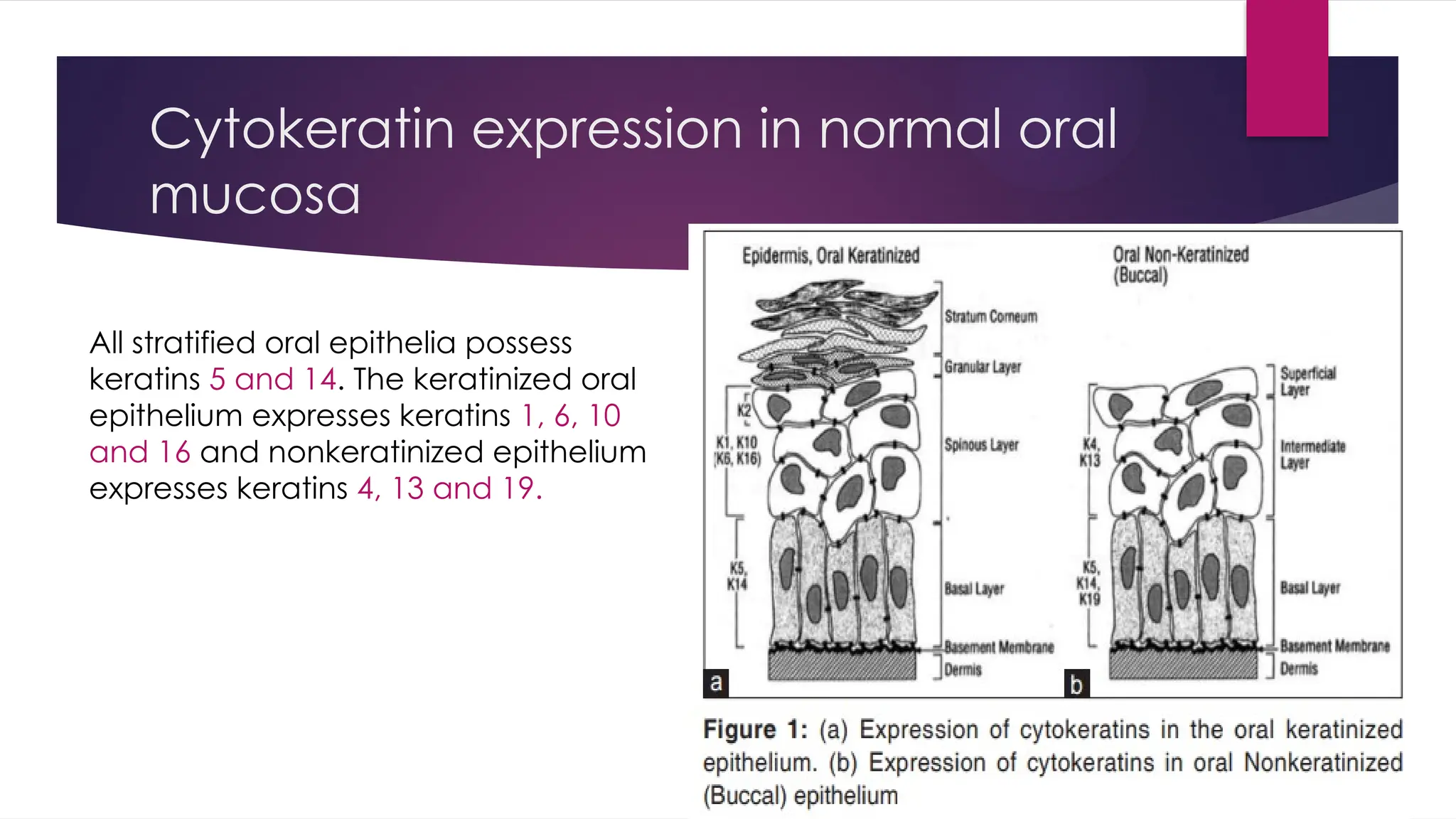 Cytokeratin expression in normal oral
mucosa
All stratified oral epithelia possess
keratins 5 and 14. The keratinized oral
epithelium expresses keratins 1, 6, 10
and 16 and nonkeratinized epithelium
expresses keratins 4, 13 and 19.
 