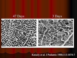 47 Days                       3 Days




          Knisely et al. J Pediatric 1988;113:1074-7
 