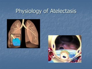 Physiology of Atelectasis
 