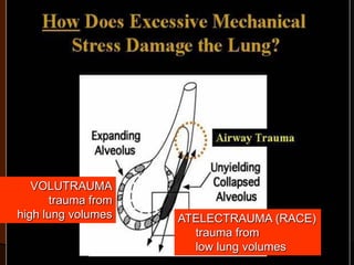VOLUTRAUMA
       trauma from
high lung volumes    ATELECTRAUMA (RACE)
                       trauma from
                       low lung volumes
 