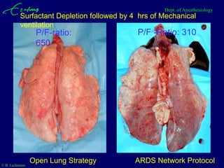 Dept. of Anesthesiology
          Surfactant Depletion followed by 4 hrs of Mechanical
          ventilation
                 P/F-ratio:                 P/F -Ratio: 310
                 650




© B. Lachmann
                Open Lung Strategy         ARDS Network Protocol
 