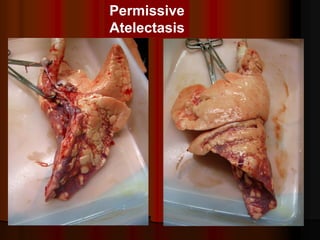 Permissive
Atelectasis
 