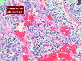 Permissive
ARDSnet
atelectasis
 