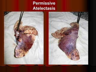 Permissive
Atelectasis
 