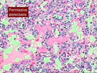 Permissive
ARDSnet
atelectasis
 