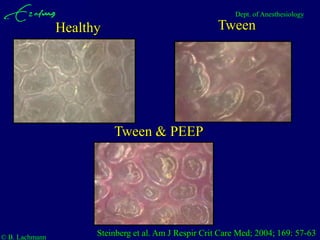 Dept. of Anesthesiology

                Healthy                                Tween




                          Tween & PEEP




© B. Lachmann
                      Steinberg et al. Am J Respir Crit Care Med; 2004; 169: 57-63
 