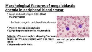 PATHOPHYSIOLOGY OF MEGALOBLSTIC ANEMIA.pptx
