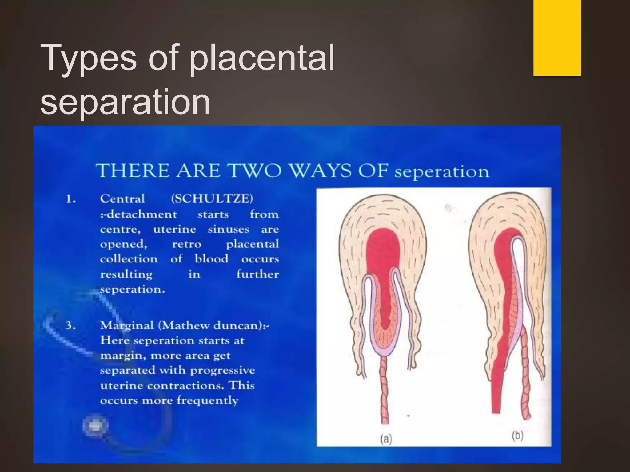 Types of placental
separation
 