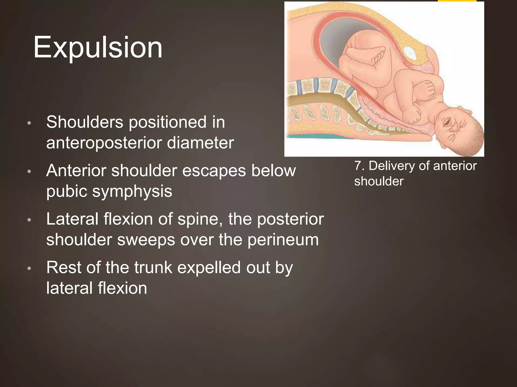 Expulsion
• Shoulders positioned in
anteroposterior diameter
• Anterior shoulder escapes below
pubic symphysis
• Lateral flexion of spine, the posterior
shoulder sweeps over the perineum
• Rest of the trunk expelled out by
lateral flexion
7. Delivery of anterior
shoulder
 