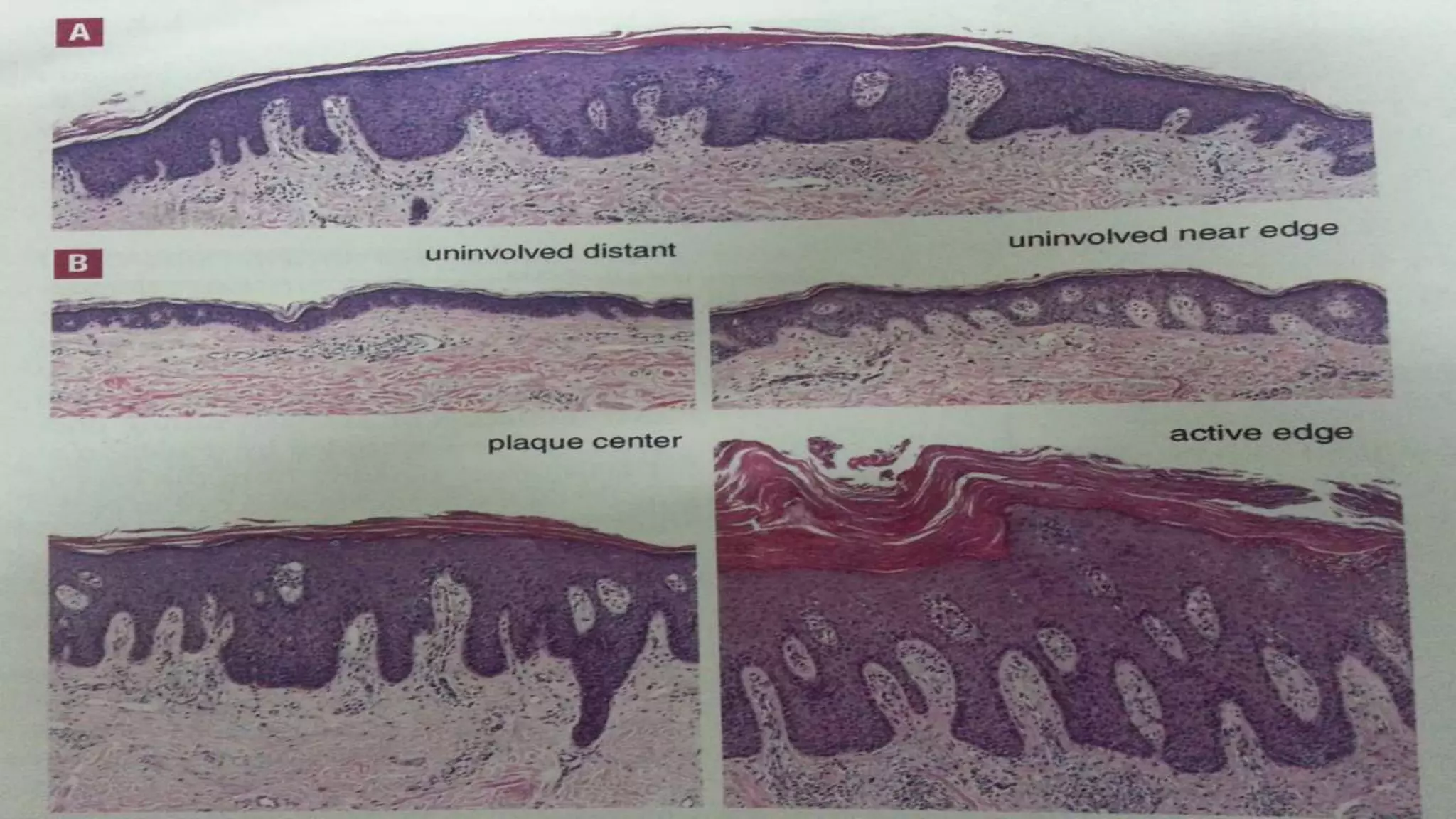 recent advances in the pathophysiology of psoriasis | PPTX