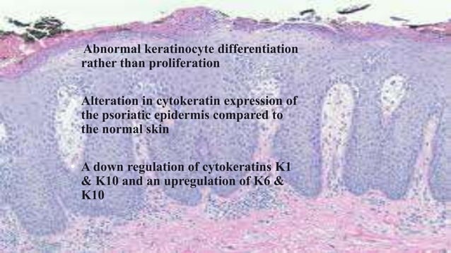 recent advances in the pathophysiology of psoriasis | PPT