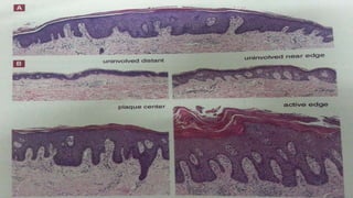 recent advances in the pathophysiology of psoriasis | PPTX