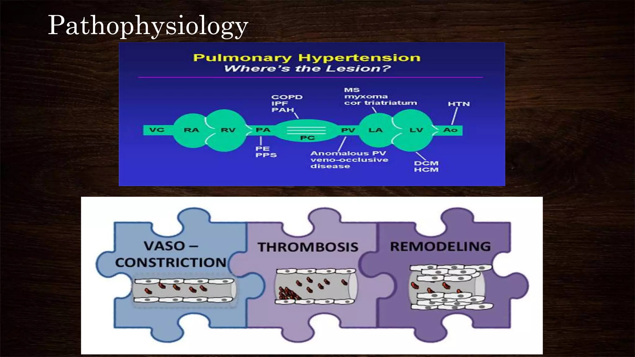 Pathophysiology of pulmonary hypertension | PPTX