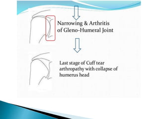 Pathophysiology of shoulder rotator cuff instability and repair | PPT