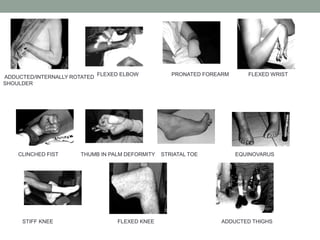 ADDUCTED/INTERNALLY ROTATED
SHOULDER
FLEXED ELBOW PRONATED FOREARM FLEXED WRIST
CLINCHED FIST THUMB IN PALM DEFORMITY STRIATAL TOE EQUINOVARUS
STIFF KNEE FLEXED KNEE ADDUCTED THIGHS
 
