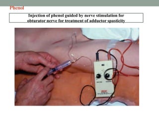 Phenol
Injection of phenol guided by nerve stimulation for
obturator nerve for treatment of adductor spasticity
 