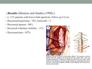Results (Mertens and Sindou (1998) )
 n =151 patients with lower limb spasticity, follow-up 5.6 yrs
 Decreased hypertonia - 78% Ashworth < 2
 Decreased spasms - 88%
 Increased voluntary mobility - 11%
 Decreased pain - 82%
 