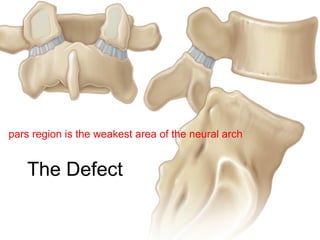 Pars Defect Types Pathophysiology of Spondylolisthesis.pptx