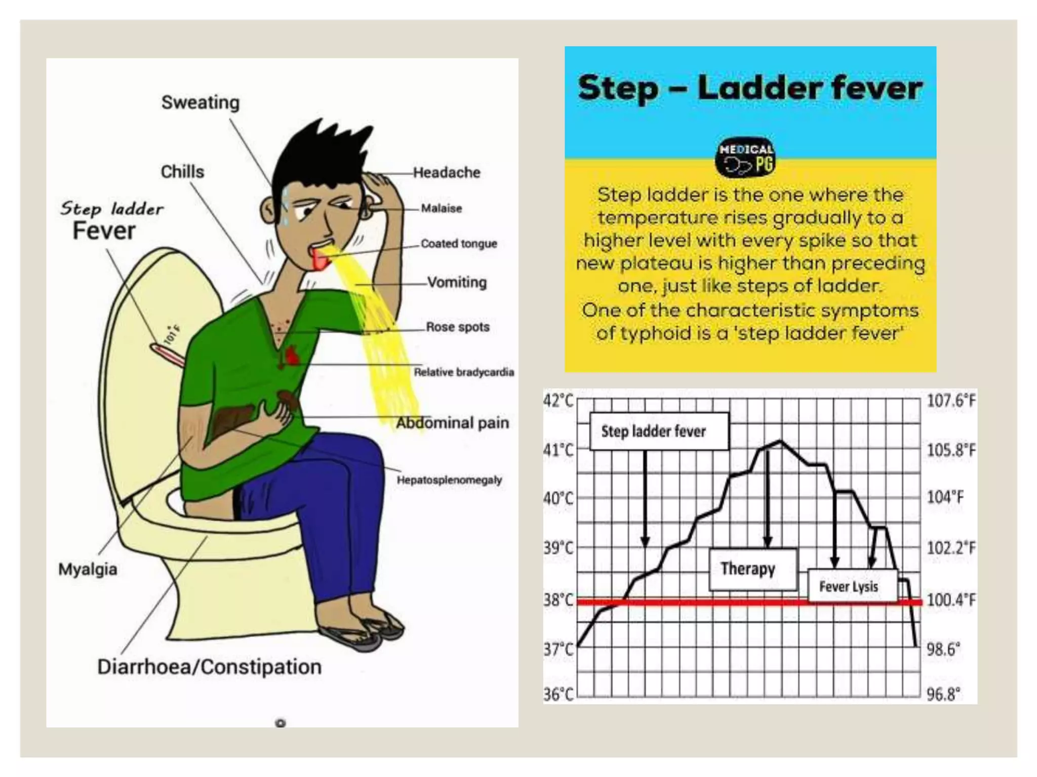 Pathophysiology of typhoid