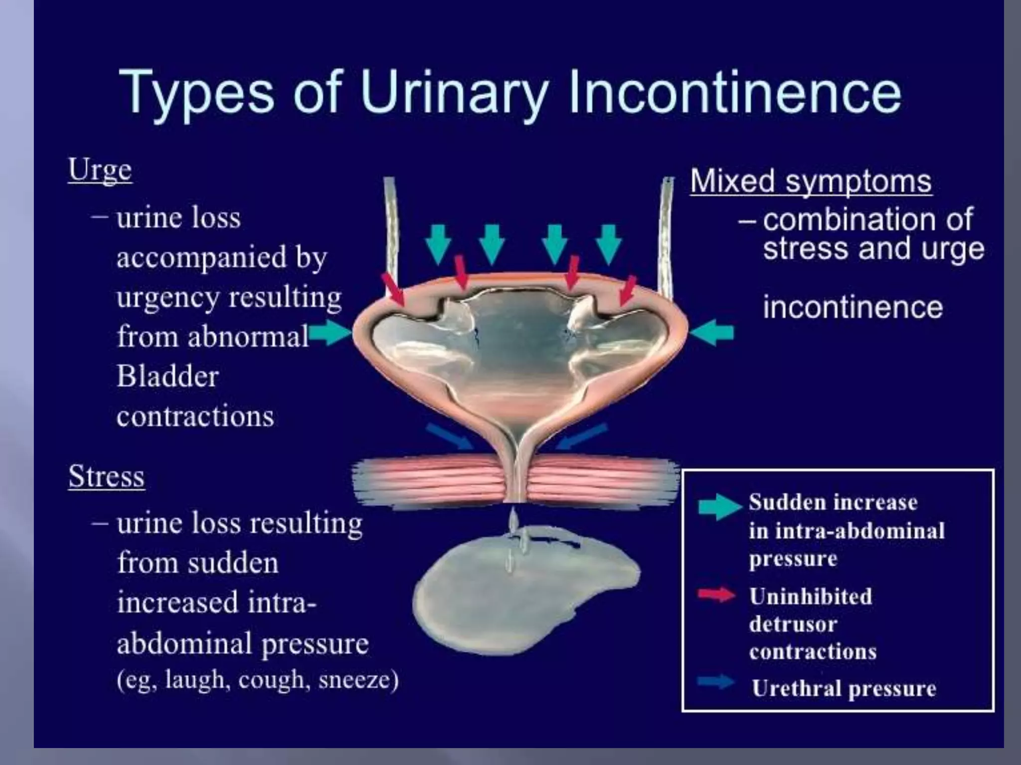 Pathophysiology of urinary incontinence