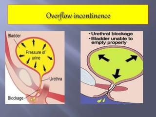 Pathophysiology of urinary incontinence | PPTX