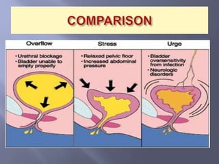 Pathophysiology of urinary incontinence | PPTX