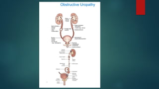 Urinary Obstruction Algorithm Pathophysiology of urinary tract obstruction.pptx