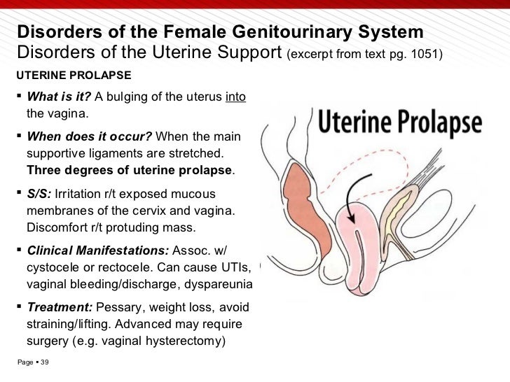 diagram of prolapsed uterus diagram prolapsed uterus choice image how to guide and diagram of prolapsed uterus diagram prolapsed uterus choice image how to guide and