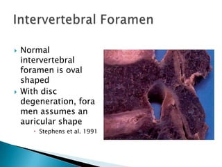  Normal
intervertebral
foramen is oval
shaped
 With disc
degeneration, fora
men assumes an
auricular shape
 Stephens et al. 1991
 