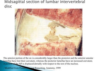 The anterior portion of the sic is considerably larger than the posterior and the anterior annular
lamellae have lost their curvature, whereas the posterior lamellae have an increased curvature.
A portion of the NP is displaced dorsally with respect to the rest of the nucleus.
- Modified from Postacchini and Rausching, Anatomy, 1999
 