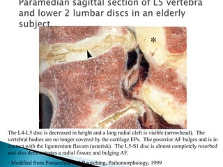 The L4-L5 disc is decreased in height and a long radial cleft is visible (arrowhead). The
vertebral bodies are no longer covered by the cartilage EPs. The posterior AF bulges and is in
contact with the ligamentum flavum (asterisk). The L5-S1 disc is almost completely resorbed
and also demonstrates a radial fissure and bulging AF.
- Modified from Postacchini and Rausching, Pathomorphology, 1999
 
