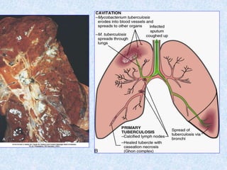 Lung Cancer (cont)
• Effects from lung cancer
• Obstruction
• Inflammation
• Pleural effusion
• Paraneoplastic syndrome
– ...