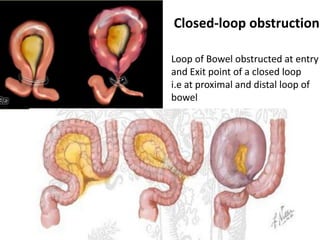 Pathopyshiology of Intestinal Obstruction CHIRANTAN MANDAL Medical ...