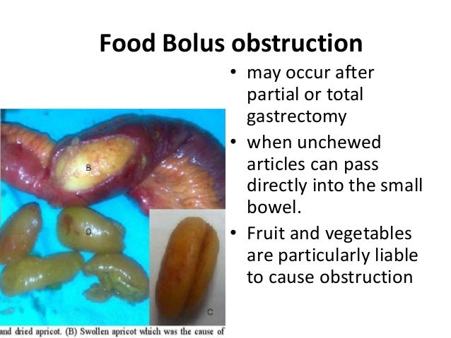 Pathopyshiology of Intestinal Obstruction CHIRANTAN MANDAL ...