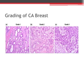 Grading of CA Breast
 