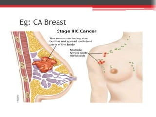 Eg: CA Breast
 