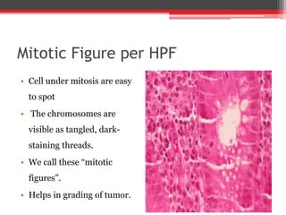 Mitotic Figure per HPF
• Cell under mitosis are easy
to spot
• The chromosomes are
visible as tangled, dark-
staining threads.
• We call these “mitotic
figures”.
• Helps in grading of tumor.
 