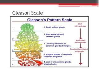 Gleason Scale
 