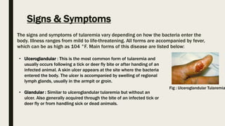 Signs & Symptoms
The signs and symptoms of tularemia vary depending on how the bacteria enter the
body. Illness ranges from mild to life-threatening. All forms are accompanied by fever,
which can be as high as 104 °F. Main forms of this disease are listed below:
Fig : Ulceroglandular Tularemia
• Ulceroglandular : This is the most common form of tularemia and
usually occurs following a tick or deer fly bite or after handing of an
infected animal. A skin ulcer appears at the site where the bacteria
entered the body. The ulcer is accompanied by swelling of regional
lymph glands, usually in the armpit or groin.
• Glandular : Similar to ulceroglandular tularemia but without an
ulcer. Also generally acquired through the bite of an infected tick or
deer fly or from handling sick or dead animals.
 