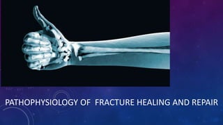 PATHOPHYSIOLOGY OF FRACTURE HEALING AND REPAIR
 