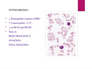 HYPOCHROMIA:
 ↓ Hemoglobin content of RBC
 ↑ Central pallor >1/3rd
.
 ↓ in MCH and MCHC
 Seen in
IRON DEFICIENCY
ANAEMIA,
THALASSAEMIA.
 