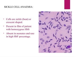 SICKLE CELL ANAEMIA:
• Cells are sickle (boat) or
crescent shaped.
• Present in film of patient
with homozygous HbS
• Absent in neonates and rare
in high HbF percentage.
 