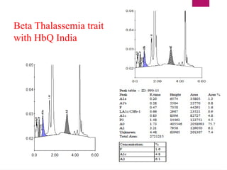 Beta Thalassemia trait
with HbQ India
 